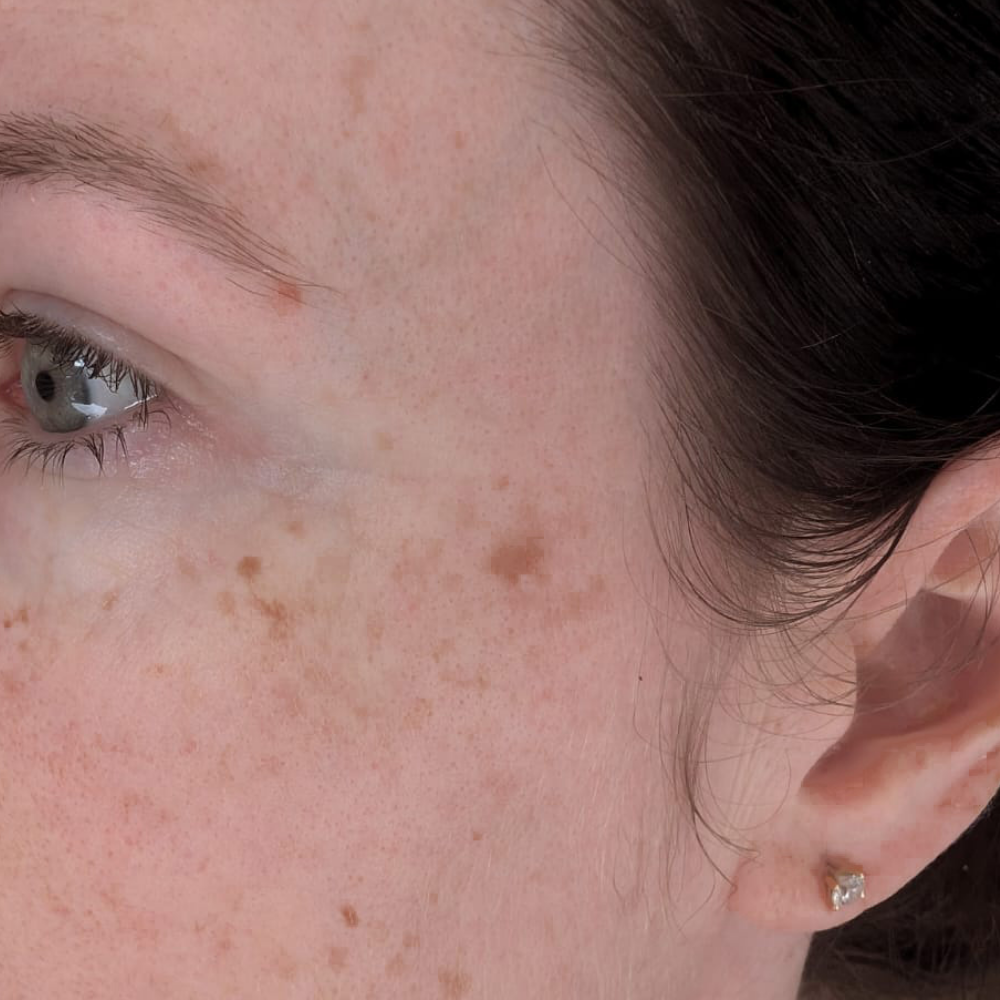 Skin hyperpigmentation before using Copper Peptide Serum